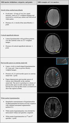 Application of an Imaging-Based Sum Score for Cerebral Amyloid Angiopathy to the General Population: Risk of Major Neurological Diseases and Mortality